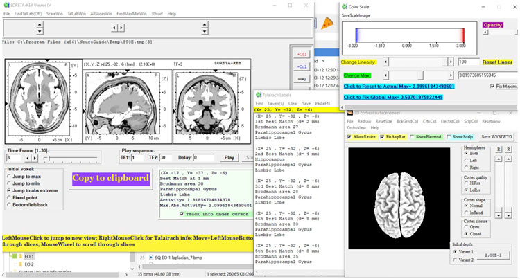 Figure 18 - Post-neurofeedback eyes-closed z-score LORETA analysis for 3 Hz